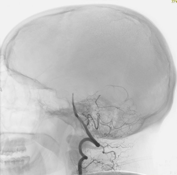 3B1 Infarct, hemorrhagic, recent, basilar, (Case 3) MRA 1 - Copy