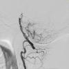 3B2 Infarct, hemorrhagic, recent, basilar, (Case 3) MRA 7 - Copy