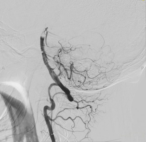 3B2 Infarct, hemorrhagic, recent, basilar, (Case 3) MRA 7 - Copy