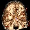 3B3 Infarct, hemorrhagic, recent, basilar, (Case 3) MRI 3 copy - Copy