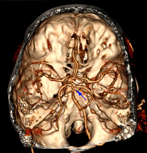 3B3 Infarct, hemorrhagic, recent, basilar, (Case 3) MRI 3 copy - Copy