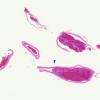 3C1 Infarct, hemorrhagic, recent, basilar, (Case 3) vessel WM copy