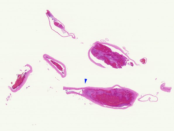 3C1 Infarct, hemorrhagic, recent, basilar, (Case 3) vessel WM copy