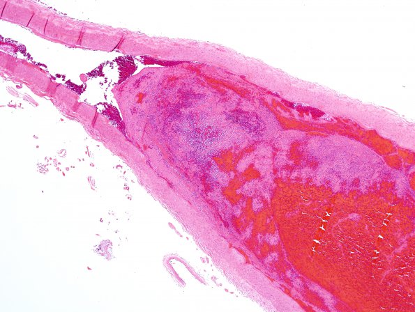 3C2 Infarct, hemorrhagic, recent, basilar, (Case 3) N10 basilar H&E 1