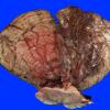 3D1 Infarct, hemorrhagic, recent, basilar, (Case 3) 3