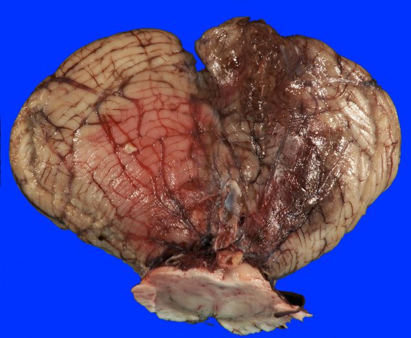 3D1 Infarct, hemorrhagic, recent, basilar, (Case 3) 3