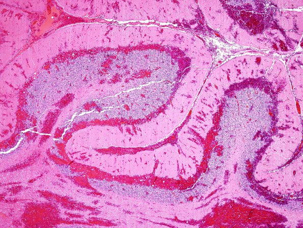 3D4 Infarct, hemorrhagic, recent, basilar, (Case 3) N9 H&E 4