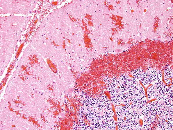 3D5 Infarct, hemorrhagic, recent, basilar, (Case 3) N9 H&E 2