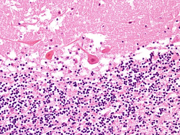 3D6 Infarct, hemorrhagic, recent, basilar, (Case 3) N9 H&E 1