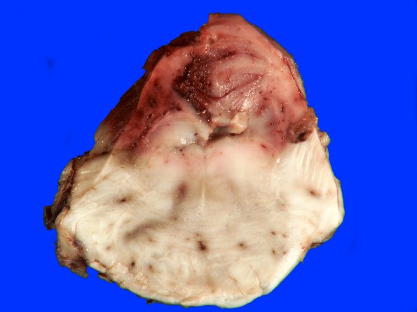 3E1 Infarct, hemorrhagic, recent, basilar, (Case 3) 7