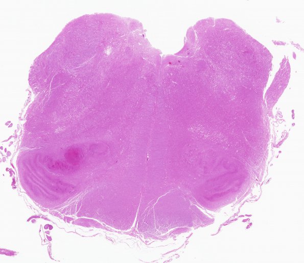 3E2 Infarct, hemorrhagic, recent, basilar, (Case 3) WM