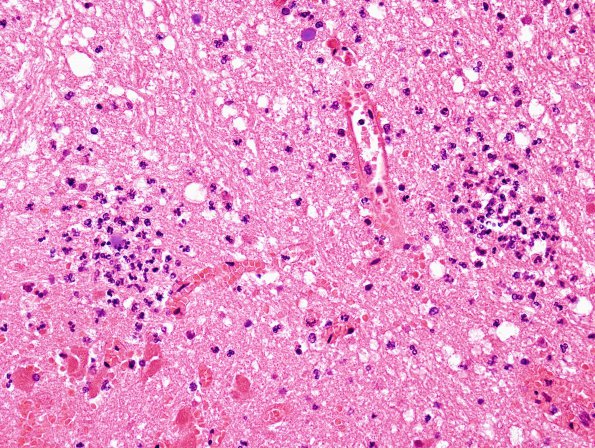 3E3 Infarct, hemorrhagic, recent, basilar, (Case 3) N8 H&E 2