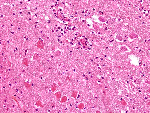 3E4 Infarct, hemorrhagic, recent, basilar, (Case 3) N8 H&E 4