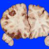 4A1 Infarct, hemorrhagic (Case 4) 5