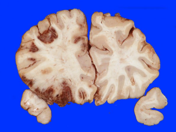 4A1 Infarct, hemorrhagic (Case 4) 5