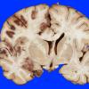 4A2 Infarct, hemorrhagic (Case 4) 4A