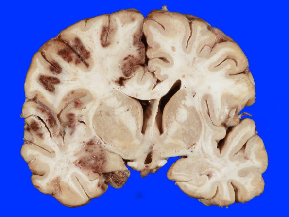 4A2 Infarct, hemorrhagic (Case 4) 4A