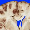 4A3 Infarct, hemorrhagic (Case 4) 5A