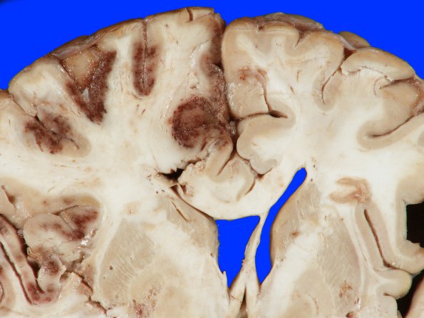 4A3 Infarct, hemorrhagic (Case 4) 5A