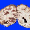 4A4 Infarct, hemorrhagic (Case 4) 17