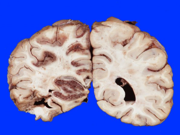 4A4 Infarct, hemorrhagic (Case 4) 17