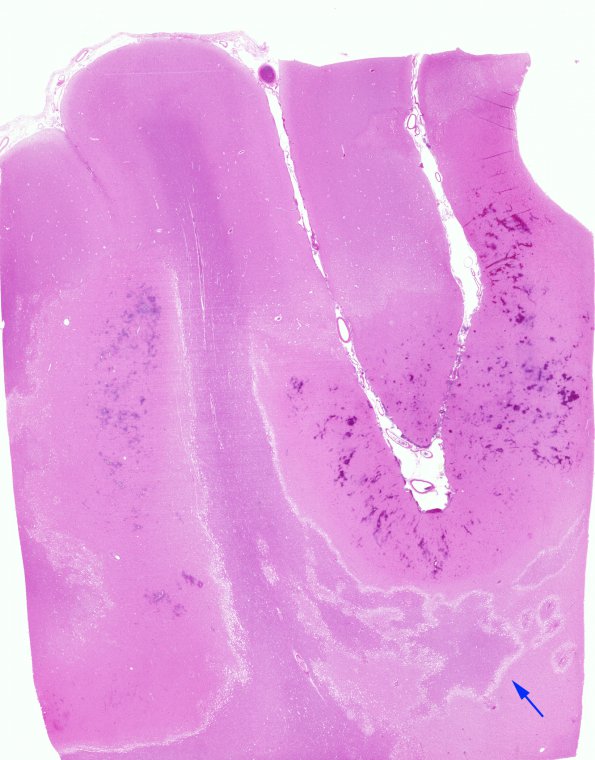 4B1 Infarct, hemorrhagic (Case 4) H&E WM copy