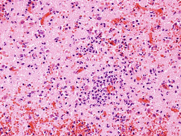 4B3 Infarct, hemorrhagic, recent (A08-7) H&E 2