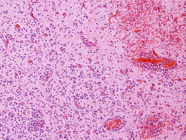 4B3 Infarct, hemorrhagic, recent (Case 4) H&E 1