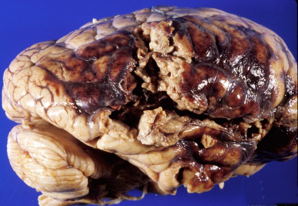 5A1 Infarct, hemorrhagic (Case 5) B