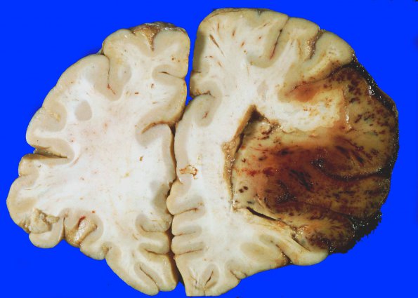 5A2 Infarct, Hemorrhagic (Case 5)