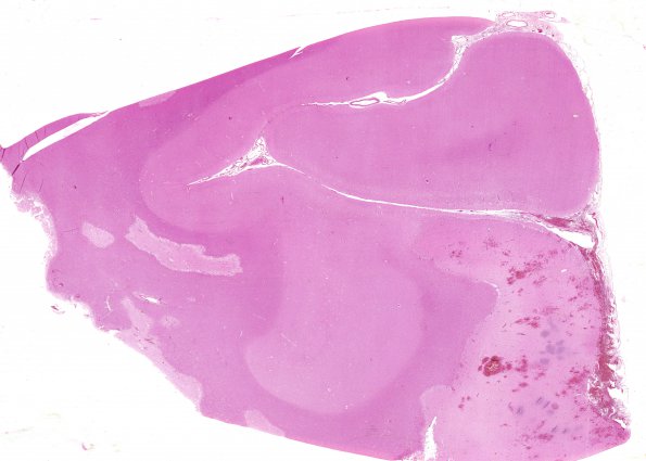 5B1 Infarct, Hemorrhagic (Case 5) WM 2