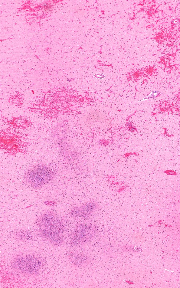 5B3 Infarct, Hemorrhagic (Case 5) G H&E 4X 2