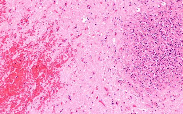 5B4 Infarct, Hemorrhagic (Case 5) G H&E 20X 2