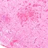 5B5 Infarct, Hemorrhagic (Case 5) G H&E 10X 2