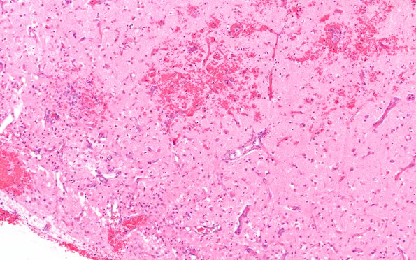 5B5 Infarct, Hemorrhagic (Case 5) G H&E 10X 2