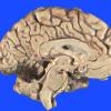 6A1 Infarct, hemorrhagic (Case 6) 1