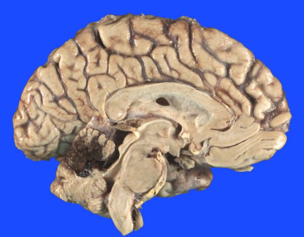 6A1 Infarct, hemorrhagic (Case 6) 1