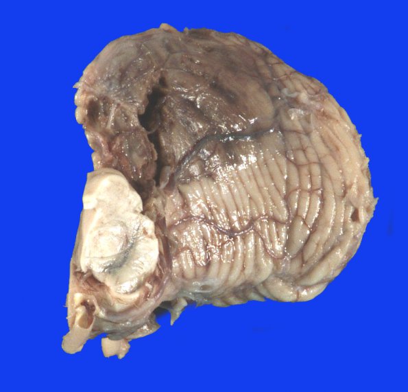 6A2 Infarct, hemorrhagic (Case 6) 2