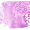 6B1 Infarct, hemorrhagic (Case 6) L14 B