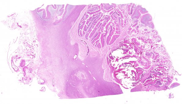 6B1 Infarct, hemorrhagic (Case 6) L14 B