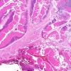 6B2 Infarct, hemorrhagic (Case 6) L14 B 4X