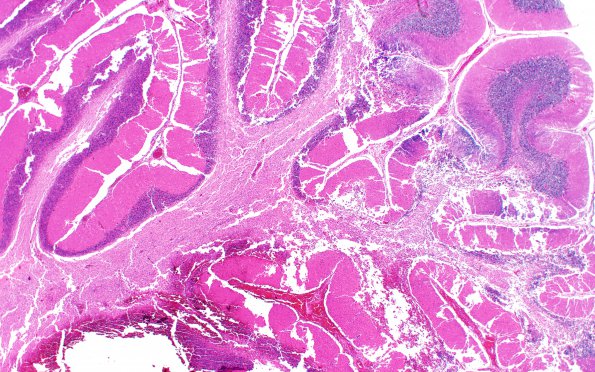 6B2 Infarct, hemorrhagic (Case 6) L14 B 4X