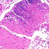 6B3 Infarct, hemorrhagic (Case 6) L14 B 20X 2