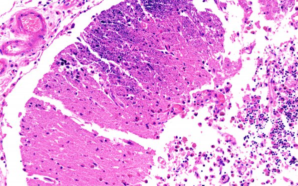 6B3 Infarct, hemorrhagic (Case 6) L14 B 20X 2