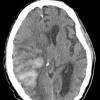 7A1 Infarct, hemorrhagic (Case 7) CT 1 - Copy