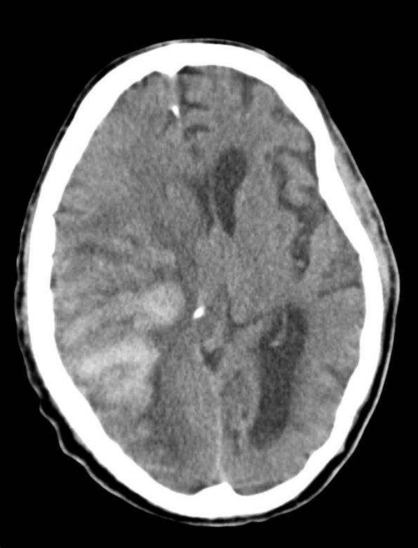 7A1 Infarct, hemorrhagic (Case 7) CT 1 - Copy