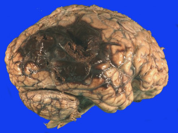 7B2 Infarct, hemorrhagic (Case 7) 2