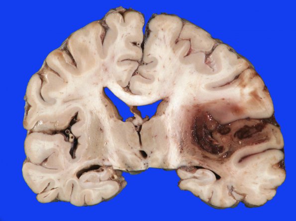 7B3 Infarct, hemorrhagic (Case 7) A_4