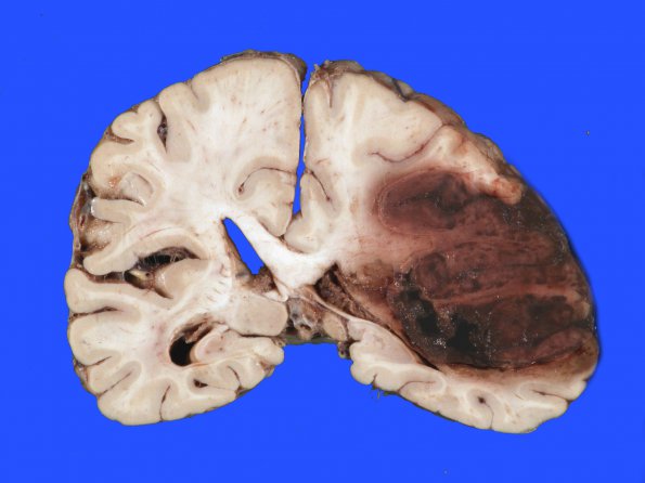 7B4 Infarct, hemorrhagic (Case 7) A_7