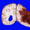 7B5 Infarct, hemorrhagic (Case 7) 8